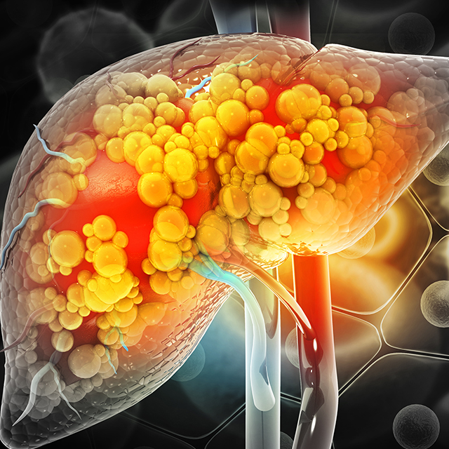 Illustration depicting diseased liver.